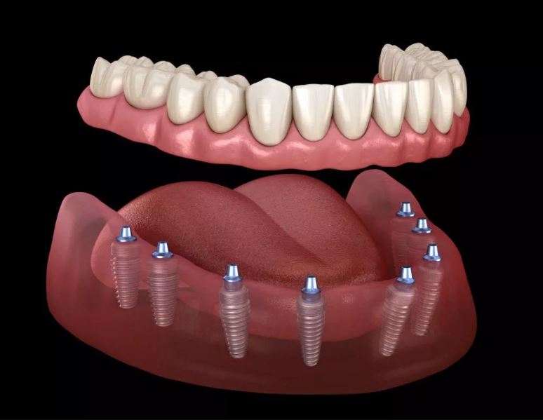 Tarifs implants dentaires all on 8 en Turquie